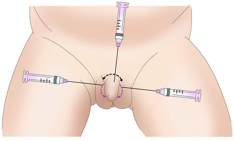penile filler