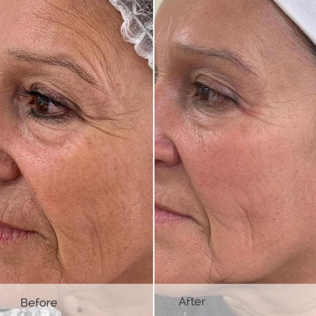 skinboosters before and after