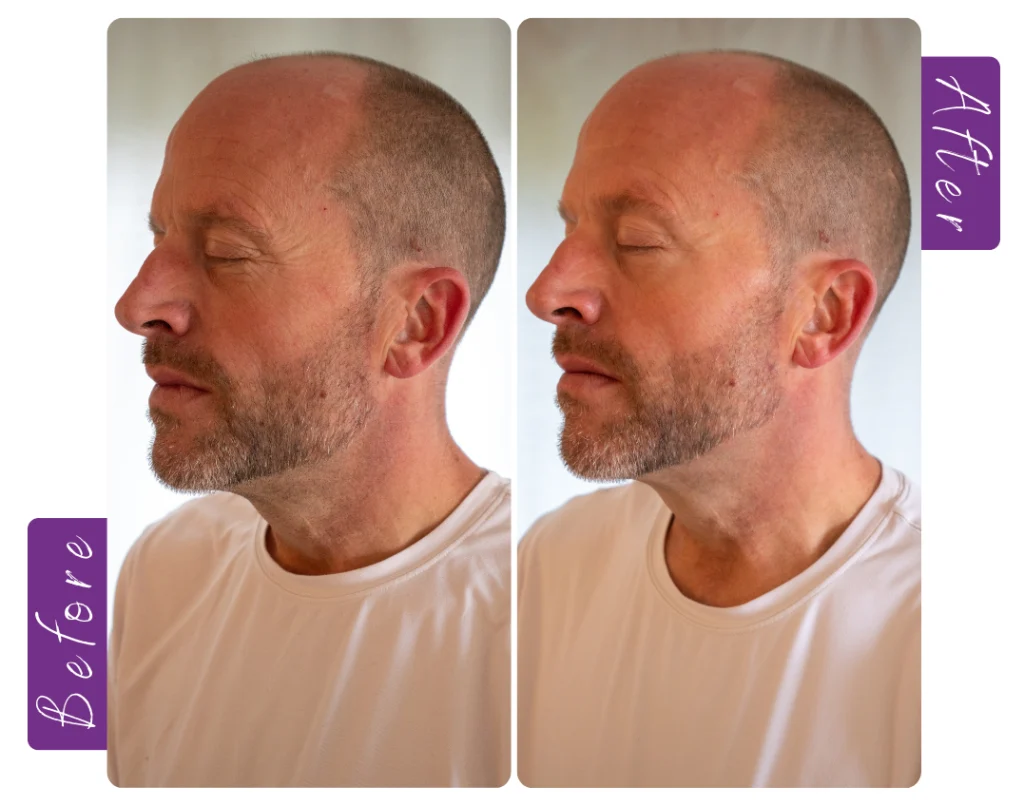 skinboosters before and after