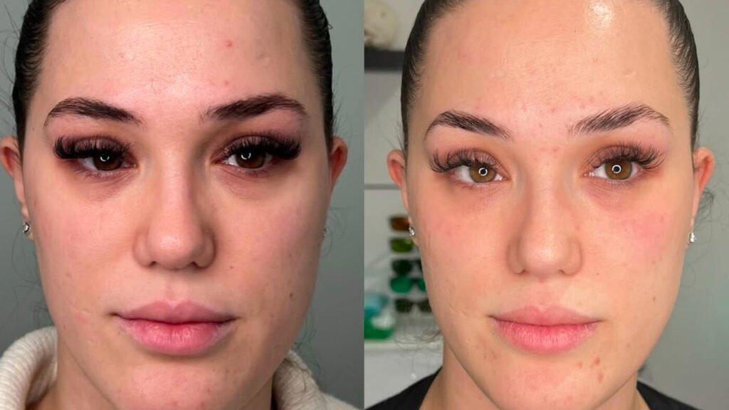 skinboosters before and after